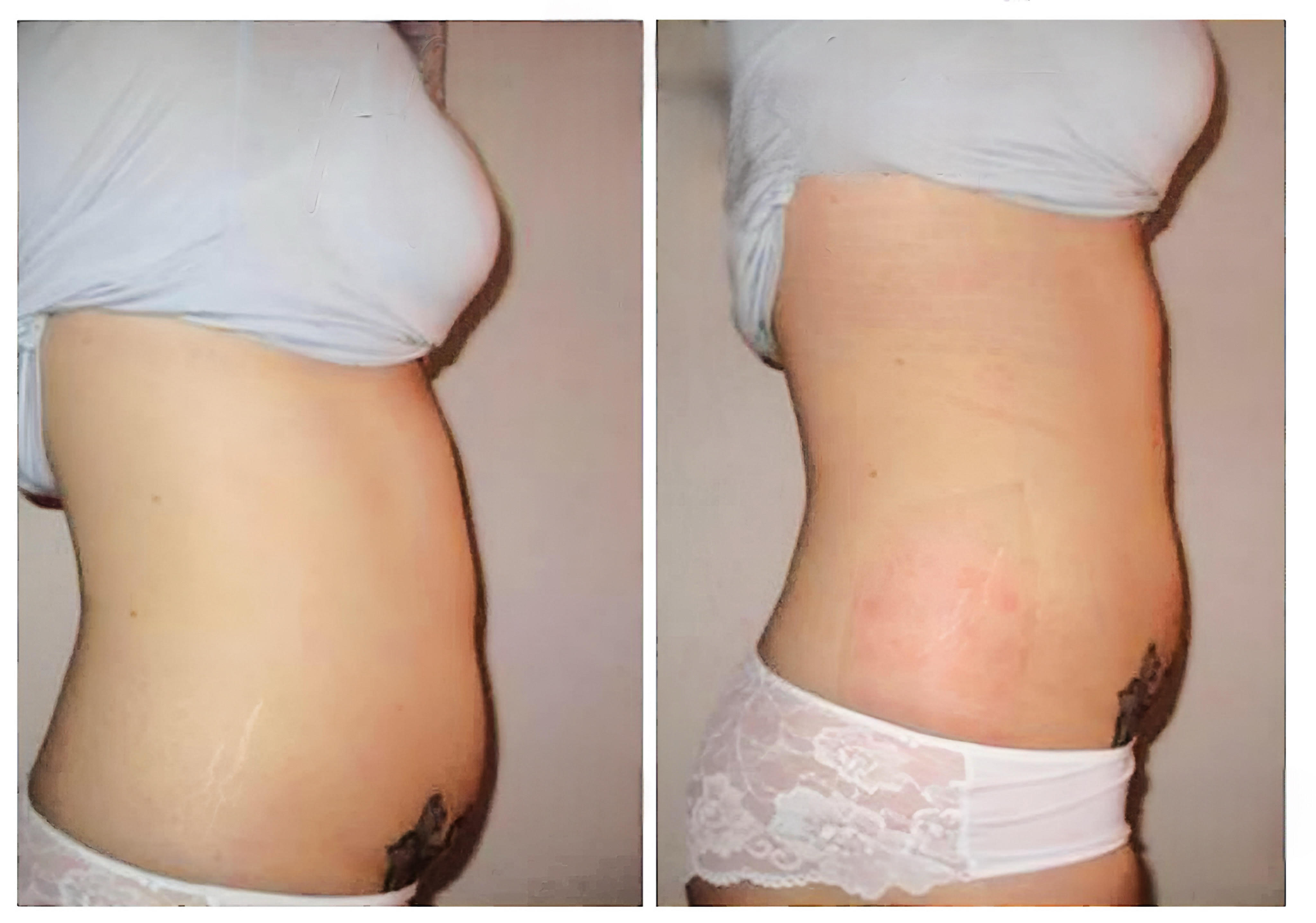 Lipolaser Treatment Before and After